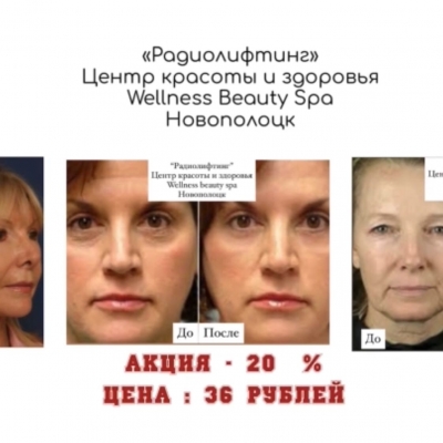 Скидка 20% на Радиолифтинг!